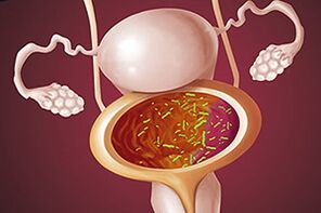 Bakteriální cystitida u ženy
